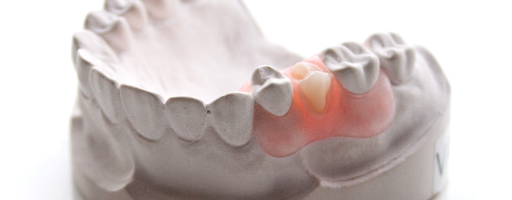 Jaw Relations In Complete Dentures Hope ID 83836
